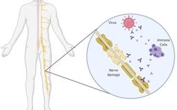 Increase in Guillain-Barré Syndrome Following AstraZeneca COVID-19 Vaccine